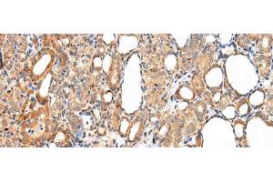 Immunohistochemistry of paraffin-embedded Human thyroid cancer tissue using AQP7 Polyclonal Antibody at dilution 1:40 (Aquaporin 7 Antikörper)