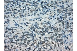 Immunohistochemical staining of paraffin-embedded Carcinoma of thyroid tissue using anti-STAT1mouse monoclonal antibody. (STAT1 Antikörper)
