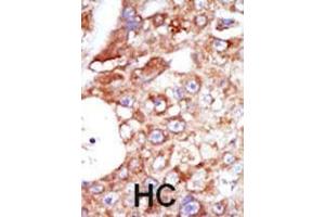 Formalin-fixed and paraffin-embedded human cancer tissue reacted with the primary antibody, which was peroxidase-conjugated to the secondary antibody, followed by AEC staining. (SYK Antikörper  (C-Term))