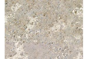 ABIN6255572 and ABIN6267110 at 1/100 staining human melanoma by IHC-P.