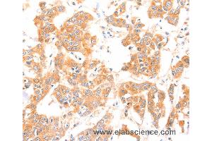 Immunohistochemistry of Human breast cancer using PRDX2 Polyclonal Antibody at dilution of 1:80 (Peroxiredoxin 2 Antikörper)