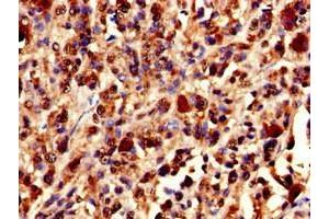 Immunohistochemistry of paraffin-embedded human melanoma using ABIN7175897 at dilution of 1:100 (XRCC5 Antikörper  (AA 251-455))