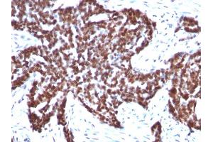 Formalin-fixed, paraffin-embedded human Ovarian Carcinoma stained with Cyclin B1 Mouse Monoclonal Antibody (CCNB1/1098). (Cyclin B1 Antikörper)
