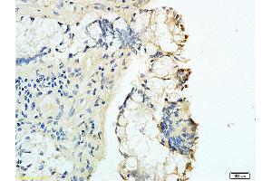 Formalin-fixed and human rectal carcinoma tissue labeled with Anti-B7-H1/PD-L1/CD274 Polyclonal Antibody, Unconjugated (ABIN737706) at 1:200 followed by conjugation to the secondary antibody and DAB staining (PD-L1 Antikörper  (AA 201-290))