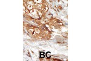 Formalin-fixed and paraffin-embedded human cancer tissue reacted with MAP3K14 polyclonal antibody  , which was peroxidase-conjugated to the secondary antibody, followed by AEC staining. (MAP3K14 Antikörper  (AA 126-155))