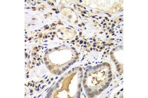 Immunohistochemistry of paraffin-embedded human gastric cancer using PSME2 antibody. (PSME2 Antikörper  (AA 1-239))