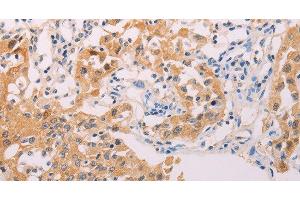 Immunohistochemistry of paraffin-embedded Human lung cancer tissue using ADHFE1 Polyclonal Antibody at dilution 1:30