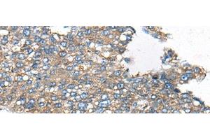 Immunohistochemistry of paraffin-embedded Human liver cancer tissue using CDC42BPA Polyclonal Antibody at dilution of 1:60(x200) (CDC42BPA Antikörper)