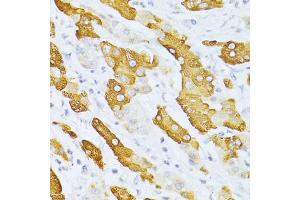 Immunohistochemistry of paraffin-embedded human liver cancer using CYP2E1 antibody (ABIN5971187) at dilution of 1/100 (40x lens).