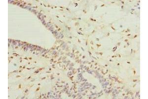 Immunohistochemistry of paraffin-embedded human breast cancer using ABIN7164641 at dilution of 1:100 (GLT25D2 Antikörper  (AA 351-626))