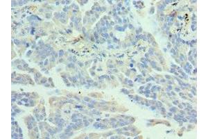 Immunohistochemistry of paraffin-embedded human lung cancer using ABIN7155475 at dilution of 1:100 (EZH1 Antikörper  (AA 160-280))
