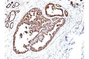 Formalin-fixed, paraffin-embedded human Breast Carcinoma stained with HSP60 Monoclonal Antibody (LK1) (HSPD1 Antikörper)