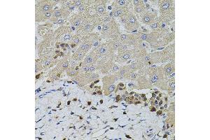 Immunohistochemistry of paraffin-embedded human liver injury using S100A12 antibody. (S100A12 Antikörper)