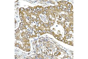 Immunohistochemistry of paraffin-embedded human lung cancer using Calumenin Rabbit mAb (ABIN7266050) at dilution of 1:25 (40x lens). (CALU Antikörper)