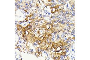 Immunohistochemistry of paraffin-embedded human lung cancer using IKKβ antibody (ABIN7267873) at dilution of 1:100 (40x lens). (IKBKB Antikörper)