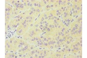Immunohistochemistry of paraffin-embedded human liver cancer using ABIN7174019 at dilution of 1:100 (FES Antikörper  (AA 120-420))
