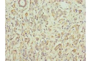 Immunohistochemistry of paraffin-embedded human pancreatic cancer using ABIN7152171 at dilution of 1:100 (Eukaryotic Translation Initiation Factor 3, Subunit M (EIF3M) (AA 1-374) Antikörper)