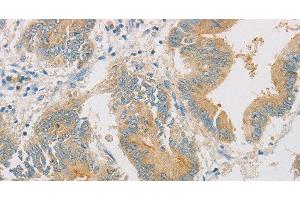 Immunohistochemistry of paraffin-embedded Human colon cancer tissue using ZWINT Polyclonal Antibody at dilution 1:50 (ZWINT Antikörper)