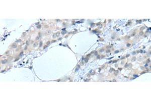 Immunohistochemistry of paraffin-embedded Human breast cancer tissue using MOG Polyclonal Antibody at dilution of 1:25(x200) (MOG Antikörper)