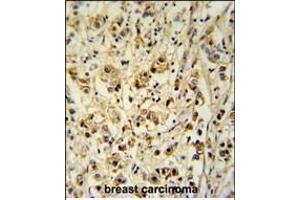 SGP Antibody (Center) (ABIN651464 and ABIN2840255) immunohistochemistry analysis in forlin fixed and paraffin embedded hun breast carcino followed by peroxidase conjugation of the secondary antibody and DAB staining. (SMAGP Antikörper  (AA 46-75))