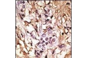 Formalin-fixed and paraffin-embedded human cancer tissue reacted with the primary antibody, which was peroxidase-conjugated to the secondary antibody, followed by DAB staining. (MAP1LC3A Antikörper  (C-Term))