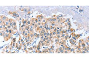 Immunohistochemistry of paraffin-embedded Human breast cancer using APOBEC3D Polyclonal Antibody at dilution of 1:80 (APOBEC3D Antikörper)