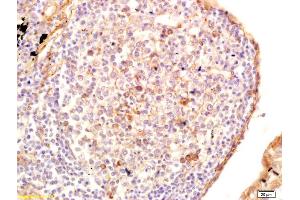 Formalin-fixed and paraffin embedded human lung carcinoma labeled with Anti-GRK6 Polyclonal Antibody, Unconjugated (ABIN1387719) at 1:200 followed by conjugation to the secondary antibody and DAB staining. (GRK4/GRK5/GRK6 (AA 181-280) Antikörper)