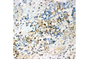 Anti- CD63 Picoband antibody, IHC(P) IHC(P): Human Intestinal Cancer Tissue (CD63 Antikörper  (AA 97-238))
