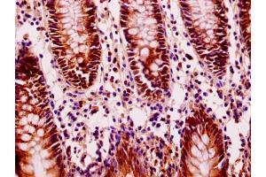 Immunohistochemistry of paraffin-embedded human colon cancer using ABIN7152940 at dilution of 1:100 (FIL1L Antikörper  (AA 1-200))