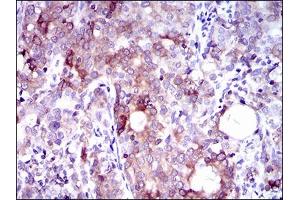 Immunohistochemical analysis of paraffin-embedded cervical cancer tissues using SLC27A5 mouse mAb with DAB staining. (SLC27A5 Antikörper  (AA 508-570))