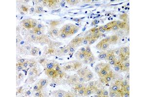 Immunohistochemistry of paraffin-embedded Human liver cancer using RARRES2 Polyclonal Antibody at dilution of 1:200 (40x lens).