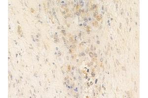 ABIN6264988 and ABIN6266659 at 1/100 staining human prostate carcinoma by IHC-P. (SENP7 Antikörper  (C-Term))