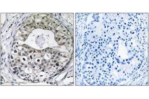 Immunohistochemistry analysis of paraffin-embedded human breast carcinoma tissue, using RPS13 Antibody. (RPS13 Antikörper  (AA 71-120))