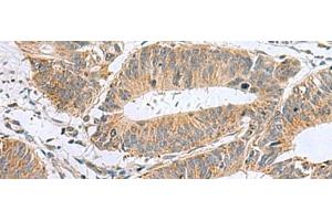 Immunohistochemistry of paraffin-embedded Human colorectal cancer tissue using MARCKSL1 Polyclonal Antibody at dilution of 1:50(x200) (MARCKSL1 Antikörper)