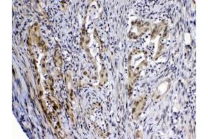 IHC testing of FFPE human rectal cancer tissue with MED4 antibody at 1ug/ml. (MED4 Antikörper)