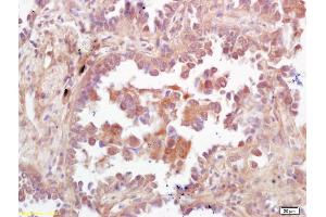 Formalin-fixed and paraffin embedded human lung carcinoma labeled with Rabbit Anti PBK/TOPK Polyclonal Antibody, Unconjugated (ABIN747608) at 1:200 followed by conjugation to the secondary antibody and DAB staining (PBK Antikörper  (AA 251-322))