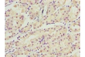 Immunohistochemistry of paraffin-embedded human gastric cancer using ABIN7175738 at dilution of 1:100 (WDR34 Antikörper  (AA 1-210))
