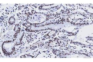 Paraffin embedded sections of human gastric cancer tissue were incubated with KLF4 monoclonal antibody, clone AT4E6 (Cat # MAB2066 ; 1 : 50) for 2 hours at room temperature.