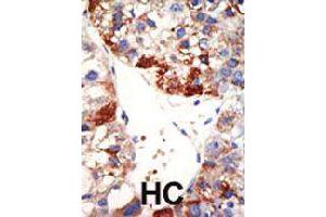 Formalin-fixed and paraffin-embedded human hepatocellular carcinoma tissue reacted with NUB1 polyclonal antibody  , which was peroxidase-conjugated to the secondary antibody, followed by DAB staining . (NUB1 Antikörper  (N-Term))