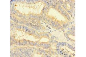 Immunohistochemistry of paraffin-embedded human endometrial cancer using ABIN7165861 at dilution of 1:100 (NIPSNAP3B Antikörper  (AA 1-247))
