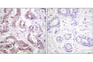 Immunohistochemistry analysis of paraffin-embedded human breast carcinoma tissue, using Survivin (Ab-34) Antibody. (Survivin Antikörper  (AA 11-60))