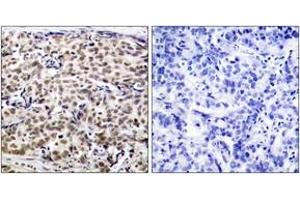 Immunohistochemistry analysis of paraffin-embedded human breast carcinoma tissue, using CREB (Ab-129) Antibody. (CREB1 Antikörper  (AA 96-145))