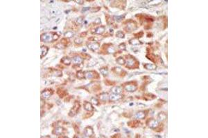 Formalin-fixed and paraffin-embedded human cancer tissue reacted with the primary antibody, which was peroxidase-conjugated to the secondary antibody, followed by DAB staining. (SRPK3 Antikörper  (Middle Region))