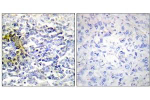Immunohistochemistry analysis of paraffin-embedded human lung carcinoma tissue using FXR2 antibody. (FXR2 Antikörper  (C-Term))