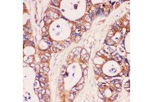 Anti-MyD88 Picoband antibody,  IHC(P): Human Intestinal Cancer Tissue (MYD88 Antikörper  (AA 44-264))