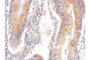 IHC-P Image AMPK gamma 2 antibody detects PRKAG2 protein at cytosol on human gastric cancer by immunohistochemical analysis. (PRKAG2 Antikörper  (full length))