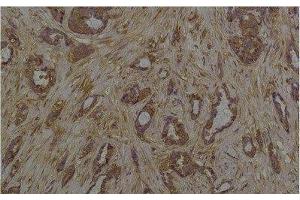 Immunohistochemistry of paraffin-embedded Human breast carcinoma tissue with Phosphoserine Monoclonal Antibody at dilution of 1:200 (Phosphoserine Antikörper)