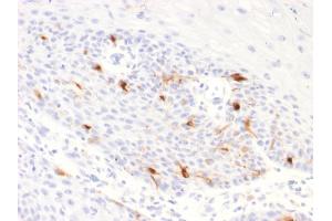 Formalin-fixed, paraffin-embedded human Basal Cell Carcinoma stained with TYRP1 Recombinant Rabbit Monoclonal Antibody (TYRP1/2340R). (Rekombinanter Tyrosinase-Related Protein 1 Antikörper  (AA 257-377))