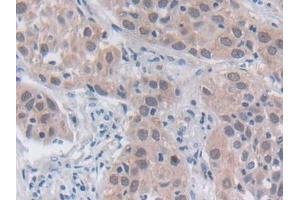 DAB staining on IHC-P; Samples: Human Lung cancer Tissue (SRY Antikörper  (AA 1-204))