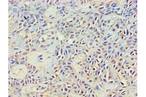 Immunohistochemistry of paraffin-embedded human breast cancer using ABIN7149353 at dilution of 1:100 (NCK2 Antikörper  (AA 1-380))